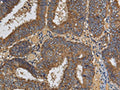 The image on the left is immunohistochemistry of paraffin-embedded Human colon cancer tissue using CSB-PA979606(KLK6 Antibody) at dilution 1/60, on the right is treated with fusion protein. (Original magnification: ×200)