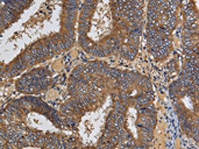 The image on the left is immunohistochemistry of paraffin-embedded Human colon cancer tissue using CSB-PA979606(KLK6 Antibody) at dilution 1/60, on the right is treated with fusion protein. (Original magnification: ×200)
