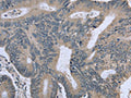 The image on the left is immunohistochemistry of paraffin-embedded Human colon cancer tissue using CSB-PA979712(BMX Antibody) at dilution 1/30, on the right is treated with fusion protein. (Original magnification: ×200)