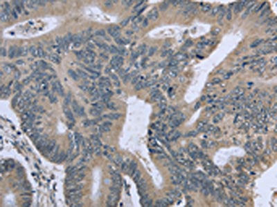 The image on the left is immunohistochemistry of paraffin-embedded Human colon cancer tissue using CSB-PA979712(BMX Antibody) at dilution 1/30, on the right is treated with fusion protein. (Original magnification: ×200)
