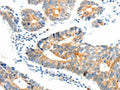 The image on the left is immunohistochemistry of paraffin-embedded Human colon cancer tissue using CSB-PA979780(NTRK1 Antibody) at dilution 1/90, on the right is treated with synthetic peptide. (Original magnification: ×200)