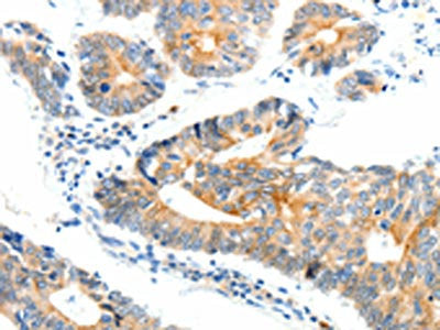 The image on the left is immunohistochemistry of paraffin-embedded Human colon cancer tissue using CSB-PA979780(NTRK1 Antibody) at dilution 1/90, on the right is treated with synthetic peptide. (Original magnification: ×200)
