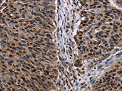 The image on the left is immunohistochemistry of paraffin-embedded Human lung cancer tissue using CSB-PA980184(KDM3B Antibody) at dilution 1/50, on the right is treated with fusion protein. (Original magnification: ×200)