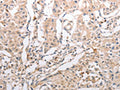 The image on the left is immunohistochemistry of paraffin-embedded Human lung cancer tissue using CSB-PA980278(INA Antibody) at dilution 1/30, on the right is treated with synthetic peptide. (Original magnification: ×200)