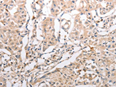 The image on the left is immunohistochemistry of paraffin-embedded Human lung cancer tissue using CSB-PA980278(INA Antibody) at dilution 1/30, on the right is treated with synthetic peptide. (Original magnification: ×200)
