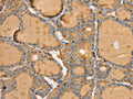 The image on the left is immunohistochemistry of paraffin-embedded Human thyroid cancer tissue using CSB-PA980348(TG Antibody) at dilution 1/40, on the right is treated with synthetic peptide. (Original magnification: ×200)