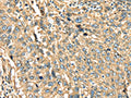 The image on the left is immunohistochemistry of paraffin-embedded Human lung cancer tissue using CSB-PA980450(ANXA2 Antibody) at dilution 1/40, on the right is treated with fusion protein. (Original magnification: ×200)