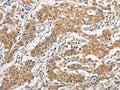 The image is immunohistochemistry of paraffin-embedded Human gastic cancer tissue using CSB-PA980626(ITGB3BP Antibody) at dilution 1/50. (Original magnification: ×200)