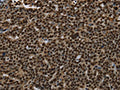 The image on the left is immunohistochemistry of paraffin-embedded Human ovarian cancer tissue using CSB-PA981207(ANP32E Antibody) at dilution 1/25, on the right is treated with synthetic peptide. (Original magnification: ×200)