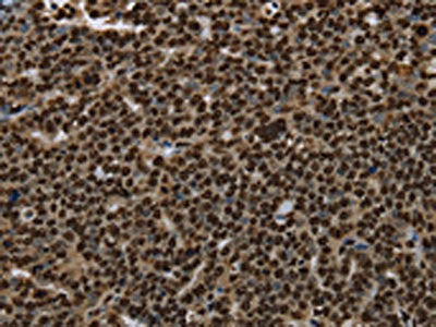 The image on the left is immunohistochemistry of paraffin-embedded Human ovarian cancer tissue using CSB-PA981207(ANP32E Antibody) at dilution 1/25, on the right is treated with synthetic peptide. (Original magnification: ×200)
