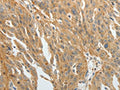 The image on the left is immunohistochemistry of paraffin-embedded Human ovarian cancer tissue using CSB-PA981490(F3 Antibody) at dilution 1/20, on the right is treated with fusion protein. (Original magnification: ×200)