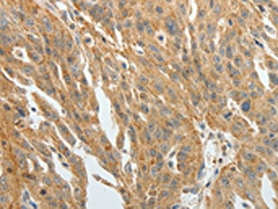 The image on the left is immunohistochemistry of paraffin-embedded Human ovarian cancer tissue using CSB-PA981490(F3 Antibody) at dilution 1/20, on the right is treated with fusion protein. (Original magnification: ×200)
