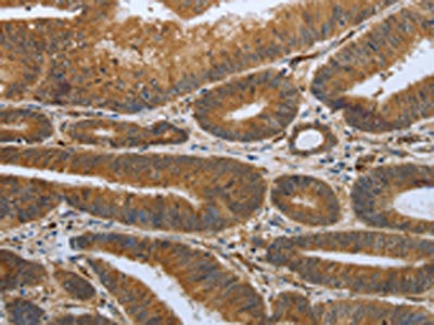 The image on the left is immunohistochemistry of paraffin-embedded Human colorectal cancer tissue using CSB-PA981705(SHBG Antibody) at dilution 1/20, on the right is treated with synthetic peptide. (Original magnification: ×200)