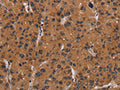 The image on the left is immunohistochemistry of paraffin-embedded Human liver cancer tissue using CSB-PA981790(NRAS Antibody) at dilution 1/40, on the right is treated with synthetic peptide. (Original magnification: ×200)