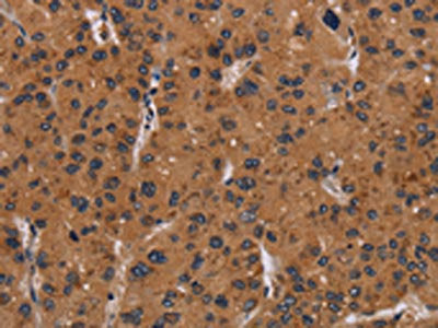 The image on the left is immunohistochemistry of paraffin-embedded Human liver cancer tissue using CSB-PA981790(NRAS Antibody) at dilution 1/40, on the right is treated with synthetic peptide. (Original magnification: ×200)