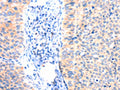 The image on the left is immunohistochemistry of paraffin-embedded Human cervical cancer tissue using CSB-PA981926(ANK3 Antibody) at dilution 1/50, on the right is treated with synthetic peptide. (Original magnification: ×200)