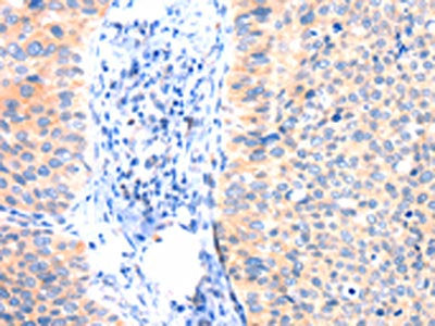 The image on the left is immunohistochemistry of paraffin-embedded Human cervical cancer tissue using CSB-PA981926(ANK3 Antibody) at dilution 1/50, on the right is treated with synthetic peptide. (Original magnification: ×200)