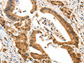 The image on the left is immunohistochemistry of paraffin-embedded Human colon cancer tissue using CSB-PA981968(HTR3A Antibody) at dilution 1/50, on the right is treated with fusion protein. (Original magnification: ×200)