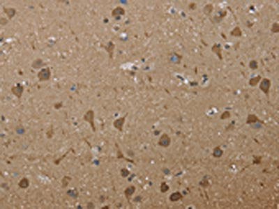 The image on the left is immunohistochemistry of paraffin-embedded Human brain tissue using CSB-PA982747(PTK2B Antibody) at dilution 1/30, on the right is treated with fusion protein. (Original magnification: ×200)