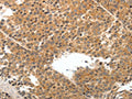 The image on the left is immunohistochemistry of paraffin-embedded Human liver cancer tissue using CSB-PA982820(TEK Antibody) at dilution 1/50, on the right is treated with synthetic peptide. (Original magnification: ×200)