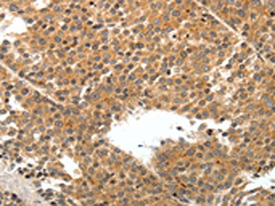 The image on the left is immunohistochemistry of paraffin-embedded Human liver cancer tissue using CSB-PA982820(TEK Antibody) at dilution 1/50, on the right is treated with synthetic peptide. (Original magnification: ×200)