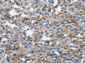 The image on the left is immunohistochemistry of paraffin-embedded Human thyroid cancer tissue using CSB-PA982897(CD177 Antibody) at dilution 1/30, on the right is treated with fusion protein. (Original magnification: ×200)