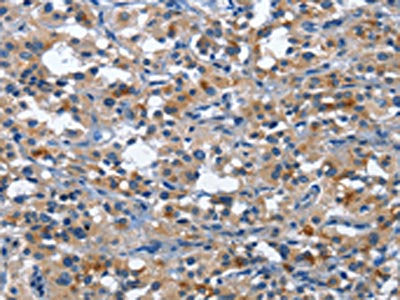 The image on the left is immunohistochemistry of paraffin-embedded Human thyroid cancer tissue using CSB-PA982897(CD177 Antibody) at dilution 1/30, on the right is treated with fusion protein. (Original magnification: ×200)
