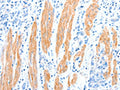 The image on the left is immunohistochemistry of paraffin-embedded Human gastic cancer tissue using CSB-PA983294(AKT3 Antibody) at dilution 1/30, on the right is treated with synthetic peptide. (Original magnification: ×200)