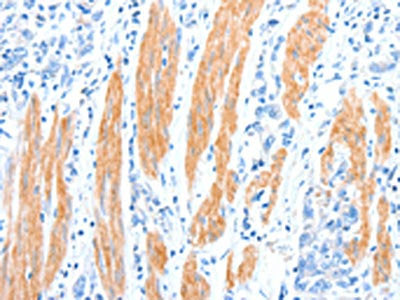 The image on the left is immunohistochemistry of paraffin-embedded Human gastic cancer tissue using CSB-PA983294(AKT3 Antibody) at dilution 1/30, on the right is treated with synthetic peptide. (Original magnification: ×200)