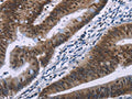 The image on the left is immunohistochemistry of paraffin-embedded Human colon cancer tissue using CSB-PA983341(HMGA1  Antibody) at dilution 1/30, on the right is treated with synthetic peptide. (Original magnification: ×200)