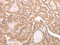 The image on the left is immunohistochemistry of paraffin-embedded Human thyroid cancer tissue using CSB-PA983505(AASDHPPT Antibody) at dilution 1/30, on the right is treated with fusion protein. (Original magnification: ×200)