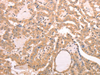 The image on the left is immunohistochemistry of paraffin-embedded Human thyroid cancer tissue using CSB-PA983505(AASDHPPT Antibody) at dilution 1/30, on the right is treated with fusion protein. (Original magnification: ×200)