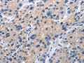The image on the left is immunohistochemistry of paraffin-embedded Human liver cancer tissue using CSB-PA983768(TNFRSF9 Antibody) at dilution 1/40, on the right is treated with fusion protein. (Original magnification: ×200)