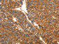 The image on the left is immunohistochemistry of paraffin-embedded Human liver cancer tissue using CSB-PA984269(ORM2 Antibody) at dilution 1/50, on the right is treated with fusion protein. (Original magnification: ×200)