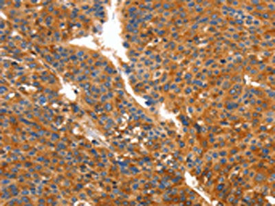 The image on the left is immunohistochemistry of paraffin-embedded Human liver cancer tissue using CSB-PA984269(ORM2 Antibody) at dilution 1/50, on the right is treated with fusion protein. (Original magnification: ×200)