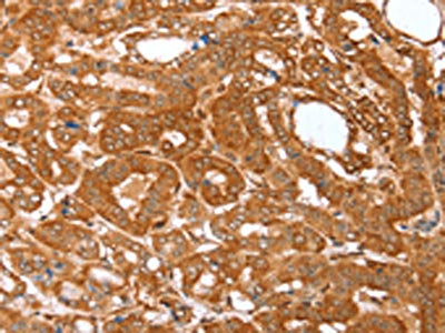 The image on the left is immunohistochemistry of paraffin-embedded Human thyroid cancer tissue using CSB-PA984347(CNN3 Antibody) at dilution 1/25, on the right is treated with fusion protein. (Original magnification: ×200)
