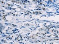 The image on the left is immunohistochemistry of paraffin-embedded Human colon cancer tissue using CSB-PA984353(ABCC1 Antibody) at dilution 1/20, on the right is treated with synthetic peptide. (Original magnification: ×200)