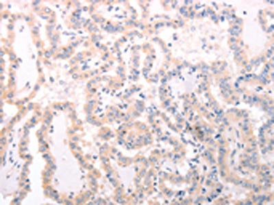 The image on the left is immunohistochemistry of paraffin-embedded Human thyroid cancer tissue using CSB-PA984438(TRAF3IP1 Antibody) at dilution 1/70, on the right is treated with fusion protein. (Original magnification: ×200)