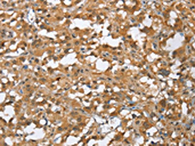 The image on the left is immunohistochemistry of paraffin-embedded Human thyroid cancer tissue using CSB-PA984456(MMP12 Antibody) at dilution 1/60, on the right is treated with fusion protein. (Original magnification: ×200)