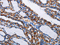 The image on the left is immunohistochemistry of paraffin-embedded Human thyroid cancer tissue using CSB-PA984502(NFKBIA Antibody) at dilution 1/15, on the right is treated with fusion protein. (Original magnification: ×200)