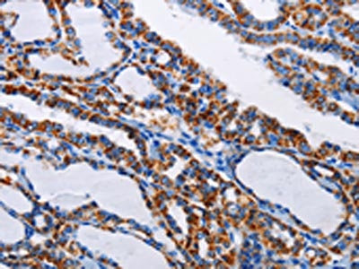 The image on the left is immunohistochemistry of paraffin-embedded Human thyroid cancer tissue using CSB-PA984502(NFKBIA Antibody) at dilution 1/15, on the right is treated with fusion protein. (Original magnification: ×200)