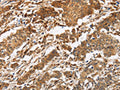 The image is immunohistochemistry of paraffin-embedded Human gastic cancer tissue using CSB-PA984693(CALU Antibody) at dilution 1/40. (Original magnification: ×200)