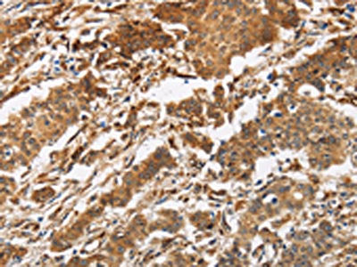 The image is immunohistochemistry of paraffin-embedded Human gastic cancer tissue using CSB-PA984693(CALU Antibody) at dilution 1/40. (Original magnification: ×200)