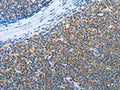 The image on the left is immunohistochemistry of paraffin-embedded Human lymphoma cancer tissue using CSB-PA984808(AMDHD2 Antibody) at dilution 1/30, on the right is treated with fusion protein. (Original magnification: ×200)