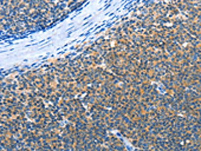 The image on the left is immunohistochemistry of paraffin-embedded Human lymphoma cancer tissue using CSB-PA984808(AMDHD2 Antibody) at dilution 1/30, on the right is treated with fusion protein. (Original magnification: ×200)
