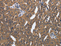 The image on the left is immunohistochemistry of paraffin-embedded Human ovarian cancer tissue using CSB-PA984889(PDGFA Antibody) at dilution 1/40, on the right is treated with synthetic peptide. (Original magnification: ×200)