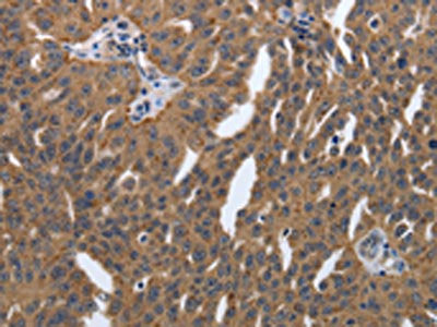 The image on the left is immunohistochemistry of paraffin-embedded Human ovarian cancer tissue using CSB-PA984889(PDGFA Antibody) at dilution 1/40, on the right is treated with synthetic peptide. (Original magnification: ×200)