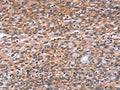 The image on the left is immunohistochemistry of paraffin-embedded Human ovarian cancer tissue using CSB-PA985124(BAP1 Antibody) at dilution 1/40, on the right is treated with fusion protein. (Original magnification: ×200)