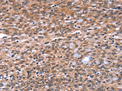 The image on the left is immunohistochemistry of paraffin-embedded Human ovarian cancer tissue using CSB-PA985124(BAP1 Antibody) at dilution 1/40, on the right is treated with fusion protein. (Original magnification: ×200)