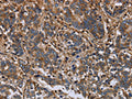 The image on the left is immunohistochemistry of paraffin-embedded Human liver cancer tissue using CSB-PA985162(FLNA Antibody) at dilution 1/40, on the right is treated with fusion protein. (Original magnification: ×200)